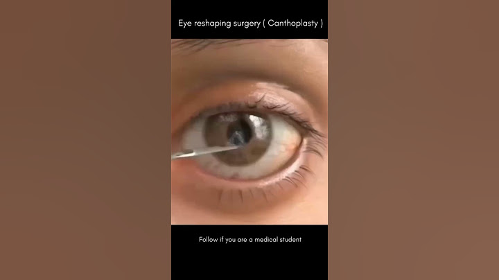 👁️ eye reshaping surgery cantho plasty #medical #life #mbbs #doctor #youtubeshort #youtubeshorts