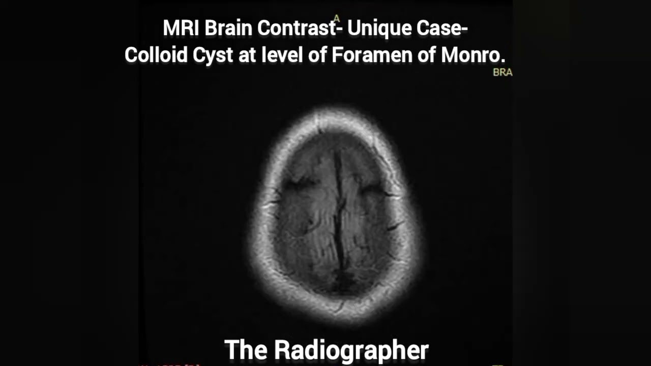 Colloid Cyst Unique Case MRI Brain | 
