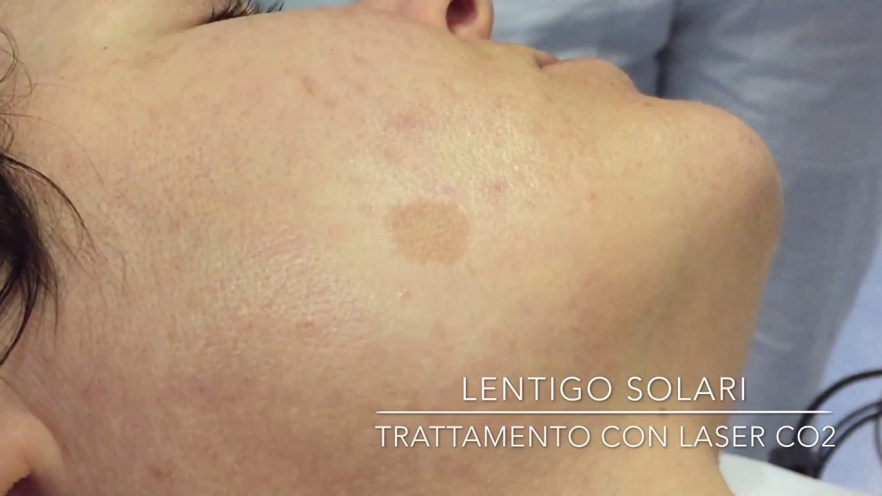 macchie solari viso laser