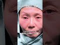 クマ取り▶50代女性（真顔だけでなく笑顔も自然なクマ取り）