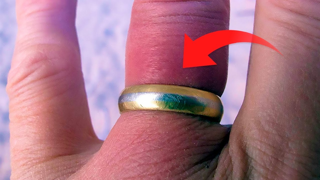 How to Remove a Ring That is Stuck on Your Finger 