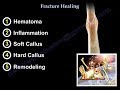 Fracture Healing - Everything You Need To Know - Dr. Nabil Ebraheim