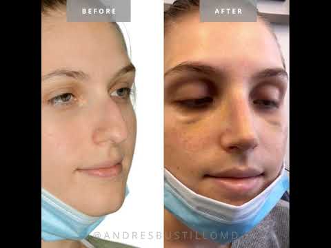 Video thumbnail: Rhinoplasty Surgery on a Female Patient performed by Andres Bustillo, M.D. · Andres Bustillo, M.D.