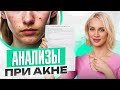 Замучили прыщи? Анализы, которые важно сдать при проблемах с кожей