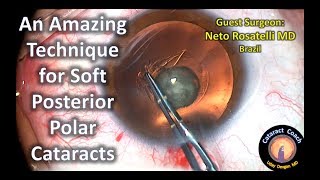 Amazing Technique For Soft Posterior Polar Cataract Surgery