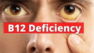 Causes, diagnosis, and treatment of vitamin B12 deficiency | Doctor explains