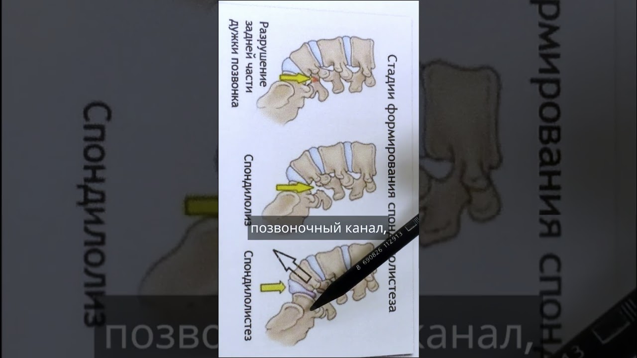 Смещение позвонков, спондилолистез - как лечить