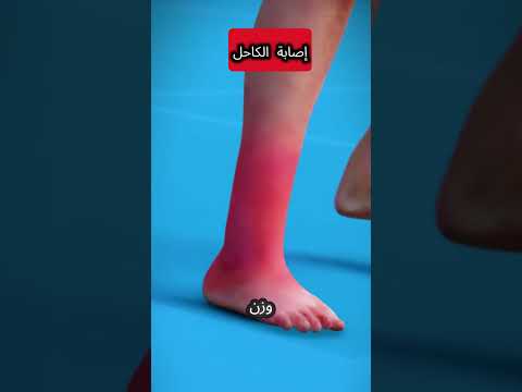 إصابة الكاحل تمزق الأربطة وتورم الكاحل  ترند اكسبلور  كيف