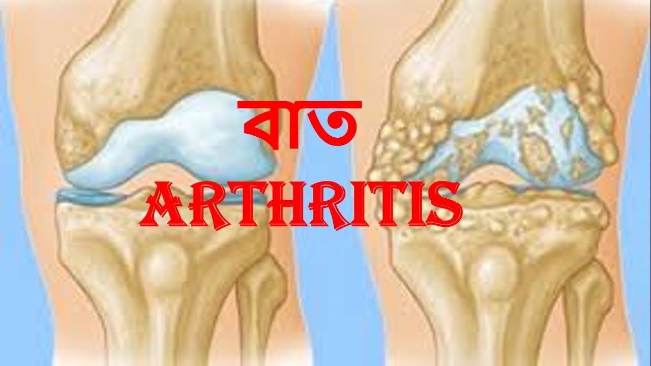 A hüvelykujj rheumatoid arthritis