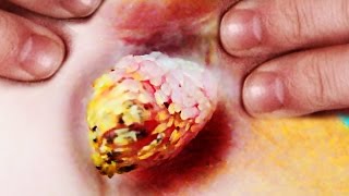 Cam sorry anal sebaceous cyst