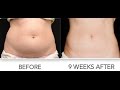 Coolsculpting Long Island New York | Freeze the Fat | Non surgical Liposuction #coolsculpting