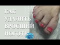 Вросший ноготь на большом пальце ноги. Удаление вросшего ногтя.