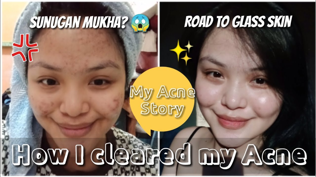 HOW I CLEARED MY PIMPLES | My Acne Story - YouTube