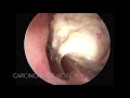 Carcinoma of nose  nasal endoscopy  dr sunil kewat