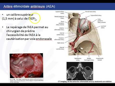 Vidéo: Prise En Charge De L'épistaxis Persistante à L'aide De La Matrice Hémostatique Floseal Vs Emballage Nasal Traditionnel: Un Essai Témoin Randomisé Prospectif