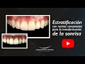 Estratificación con resinas compuestas para la transformación de la sonrisa