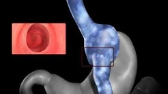 Endoscopic Suturing for Weight Gain After Bariatric Surgery | UCLA Digestive Dieseases