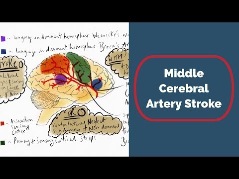 Middle Cerebral Artery Stroke