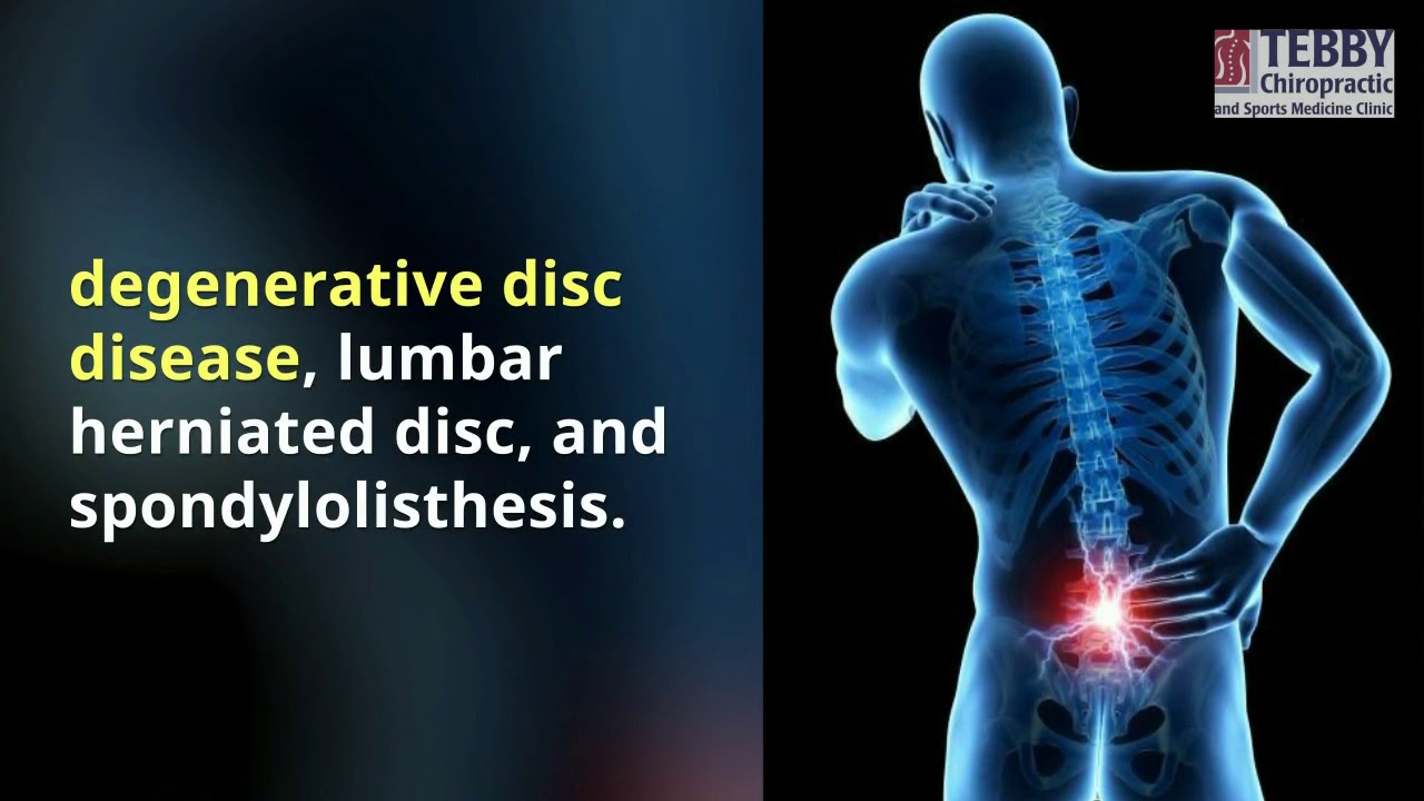 Sciatica and Chiropractic care with a Charlotte Chiropractor | Tebby Clinic