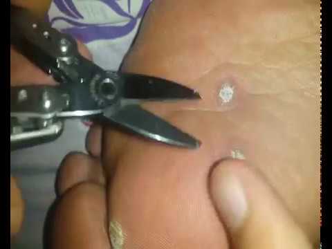 Traitement Des Cors Au Pieds Remove A Plantar Wart علاج مسمار