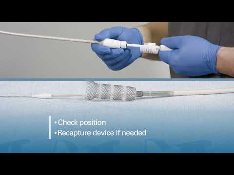Esophageal Stent Tutorial
