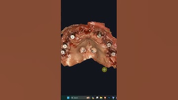 Short tutorial on iCam library modifications for exocad.