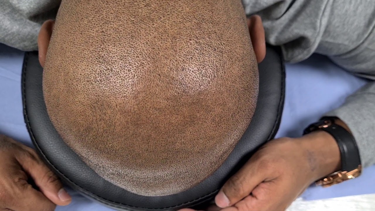 Healed Hair Tattoo SMP Scalp Micro Pigmentation @ Perfect Definition by El Truchan in London