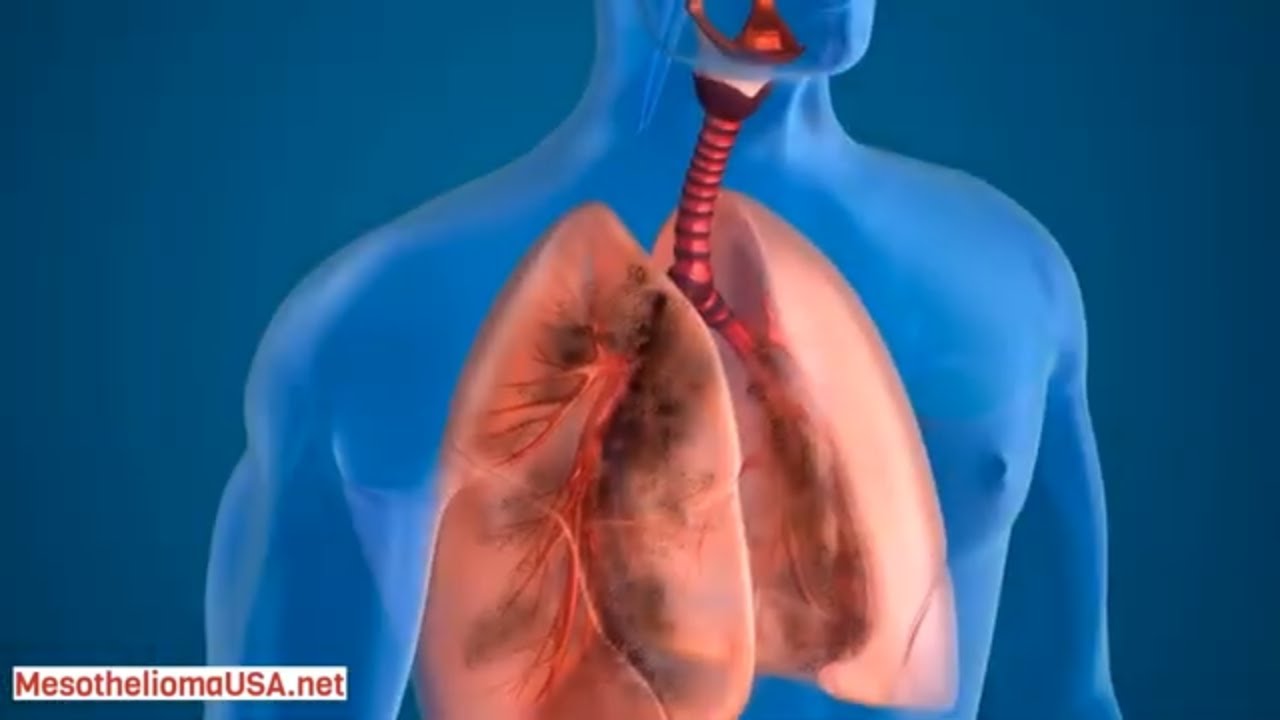 SIMIAN VIRUS 40 MESOTHELIOMA - SV40 WORKING GROUP