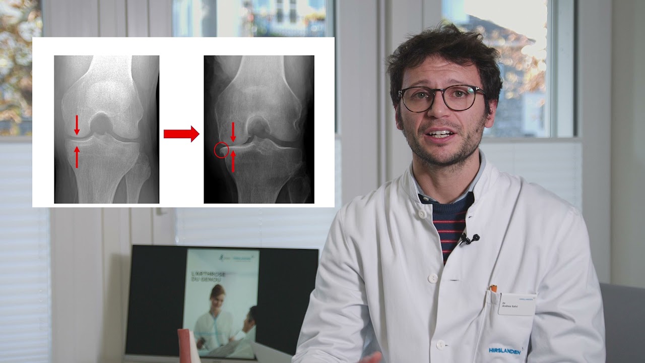 L'arthrose au genou  Physiotherapie Physio-Santé