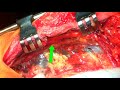 How to harvest the left internal mammary artery (LIMA) :  Part 1