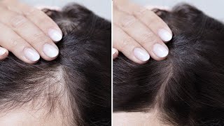 تجربتي معتساقط الشعرانبات الفراغات زيادة طول الشعرعلاج الصلععلاج تساقطneoptéde lotionducray 