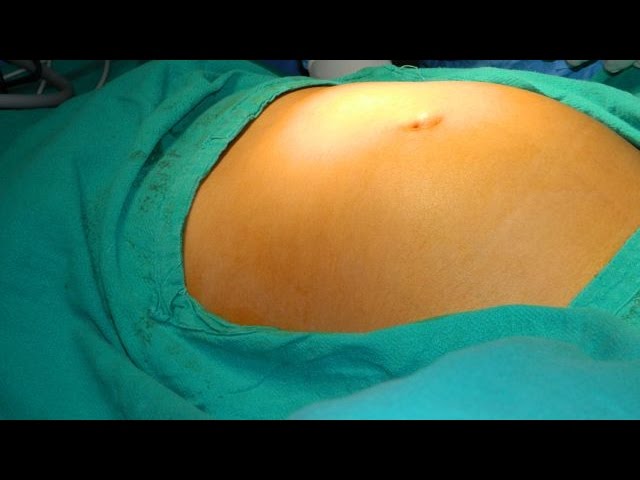 Ooforectomia por video / Video Oophorectomy 