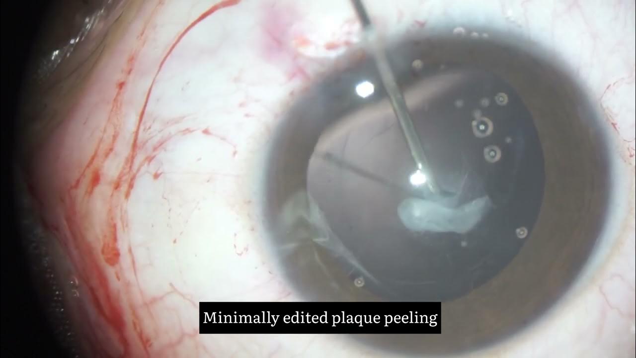 Lens aspiration and capsular plaque peeling for management of