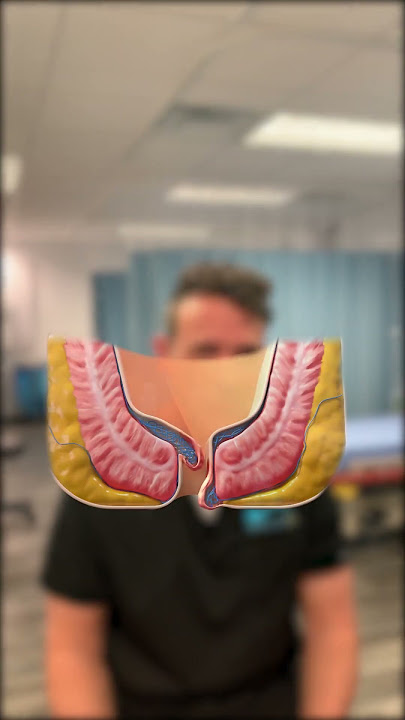 Internal vs External Hemorrhoids: What's the Difference?