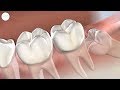 Wisdom Teeth Removal in Modesto CA | Greater Modesto Dental Implant & Oral Surgery Center