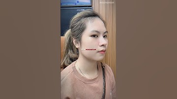 Nâng mũi cấu trúc 4D - Sau 1 năm vẫn đẹp như ngày đầu