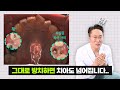 심한 충치, 그냥 더 쓰다가 갈아 엎으신다구요? 그러지 마요~ 새까매도 레진 치료 가능한 경우부터, 방치했다가 치아 넘어진 사연까지!