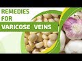 Natural Home Remedies for Varicose Veins
