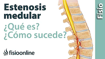 ¿Cómo diagnostica un médico la estenosis espinal?