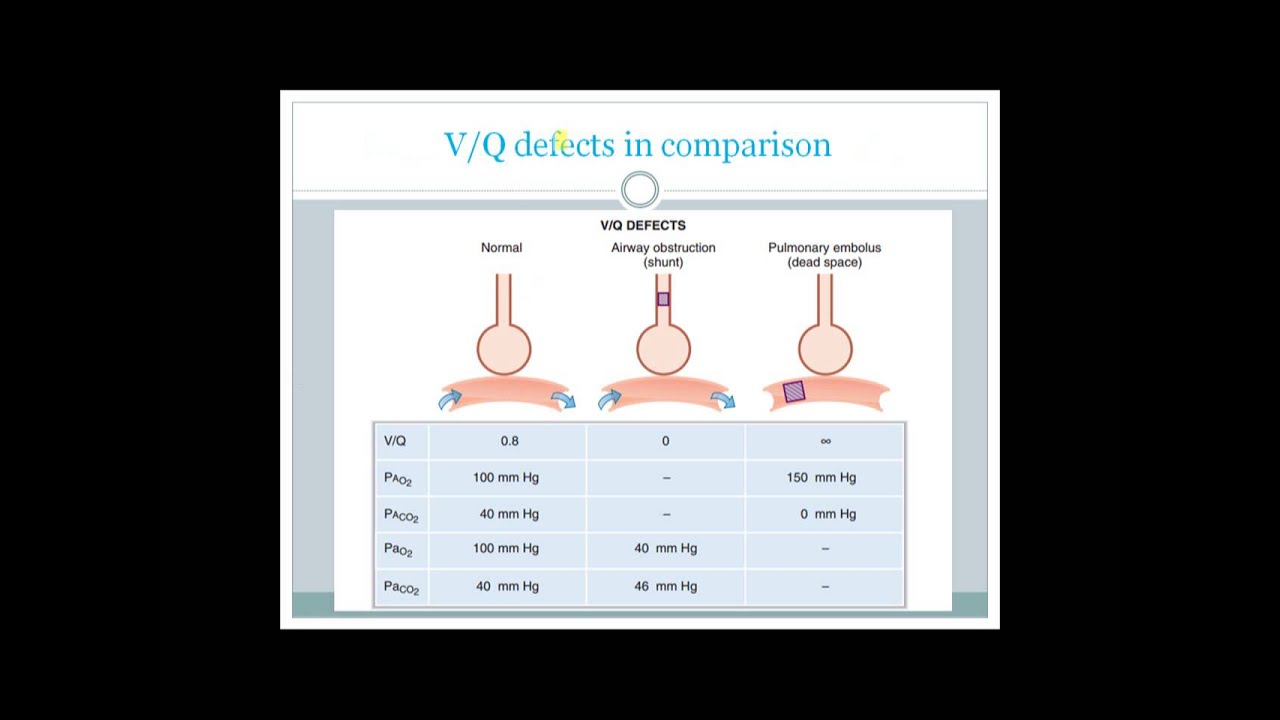 V Q Ratio And V Q Mismatch Usmle Step 1 Youtube