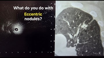 Airway Mapping Made Easy! (Bronchial Branch Tracing) Left Upper Lobe LB1+2
