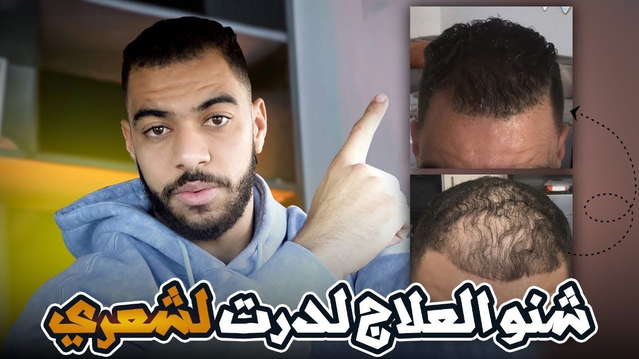 شنو هو العلاج لدرت لشعري  🤔