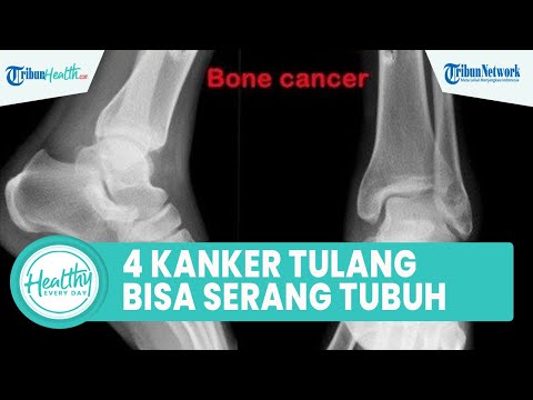 Video: Tanda radiologis apa yang berhubungan dengan osteosarkoma?