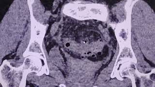 Acute diverticulitis - case presentation - CT findings