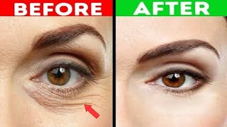 Reasons and Treatment Of wrinkle and Fine lines under the eyes |Dr.Vivek Joshi