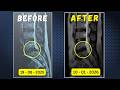 L5 S1 Disc Extrusion Reabsorbed Without Surgery In 6 Months L5 S1 Disc Extrusion Reabsorbed Without Surgery In 6 Months