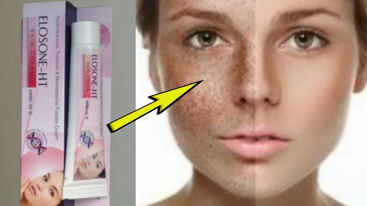 Elosone Ht Cream Remove Pigmentation Melasma Damage Skin Review In Hindi Youtube