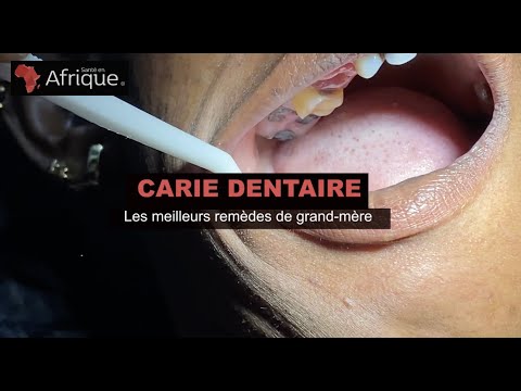 Carie dentaire: comment apaiser la douleur