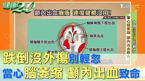 跌倒沒外傷別輕忽 當心腦萎縮 顱內出血致命 健康2.0 - 天天要聞