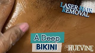 You Dont Have To Remove Everything A Deep Bikini - Laser Hair Removal Session | HueVine